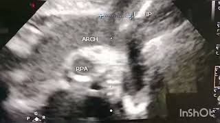 Bed side ultrasound determination of ET tip.0.5 cm away from arch of aorta