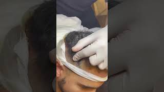 Best DHI, Best Result #hairtransplant #haartransplant #turkeyhairtransplant #haartransplantatie