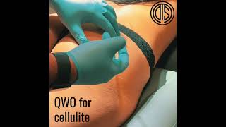 QWO: the first and only FDA-approved injectable for cellulite