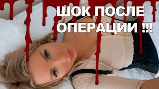 ЛИПОСАКЦИЯ И ЛИПОФИЛИНГ  В КЛИНИКЕ ДЕГА СПБ 🚫 ЧАСТЬ 2 - РЕЗУЛЬТАТ