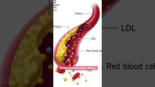 High cholesterol and heart attack #diettips #nutritionist