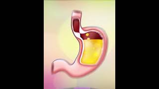 Apple Cider Vinegar To STOP ACID REFLUX