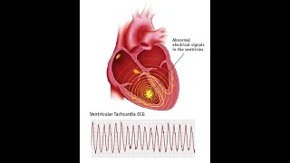 ventricular tachycardia