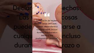 mitos sobre las venas varicosas #doctor #health #spiderveins #healthcare #foot #salud #veinhealth