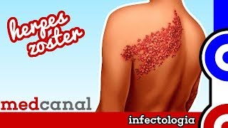 Herpes Zoster | INFECTOLOGIA