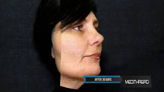 PDO-THREAD LIFT TUTORIAL BY MEDiTHREAD - CHEEK LIFT