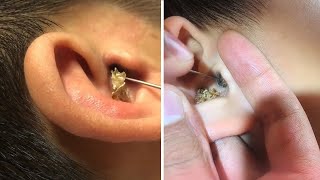 Difficult Ear Wax Removal from Both Ears