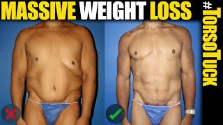 Massive Weight Male Plastic Surgery for Men in NYC and LA