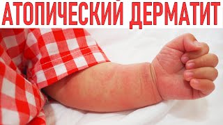 АТОПИЧЕСКИЙ ДЕРМАТИТ У ДЕТЕЙ. Правильный уход за кожей при дерматите