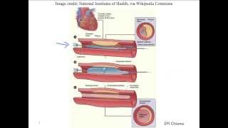 Acute coronary syndrome (Part 4)