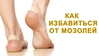 КАК БЫСТРО ИЗБАВИТЬСЯ ОТ МОЗОЛЕЙ НА НОГАХ