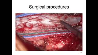 Surgical tactics of schwannoma removal