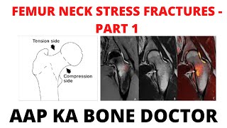 FEMORAL NECK STRESS FRACTURES - PART 1 - EPISODE 12