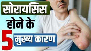 Causes Of Psoriasis Skin Disease | सोरायसिस होने के 5 मुख्य कारण | Psoriasis Hone Ke 5 Sanket