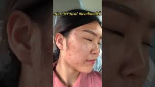 salep jerawat #fypage #skincare #trendingtopicsonyoutube #fypyoutube