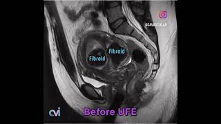 MRI before and 6 months after uterine fibroid embolization UFE - center top doctor - results