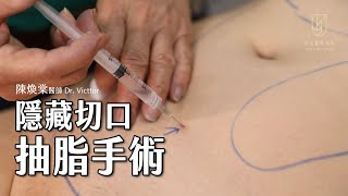 【抽脂手術】隱藏抽脂切口｜#陳煥棠教授 Dr. Samuel｜#金貞醫學美容