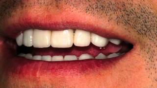 Before/After Dental Veneers - Worn Teeth