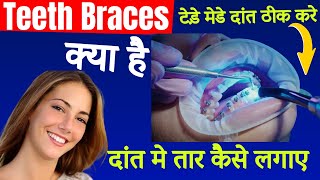 teeth braces kya hai | Teeth braces kaise karaye || dant me tar kaise lagaye | Rakesh Godara