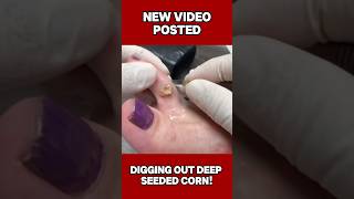 SUPER DEEP Corn Removal! #shortsvideo #nails #cornremoval