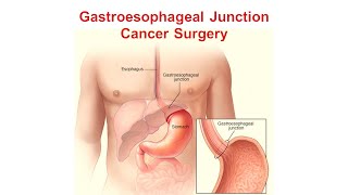 Gastroesophageal Junction Adenocarcinoma (Proximal Stomach, GE Junction) by Dr Majid Ahmad Talikoti