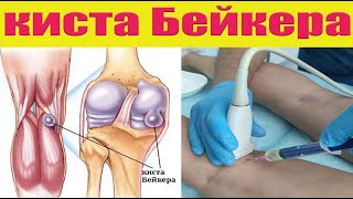 Киста Бейкера. Причины, лечение, осложнения..