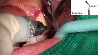 Bone Block with Dr  Eric Park