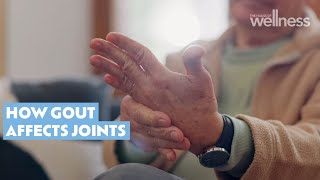 Your sore joints might be a sign of gout