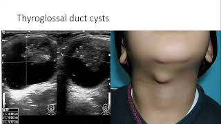 Thyroid Ultrasound and Associated Pathology