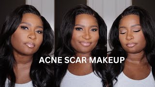 **Detailed Makeup GRWM ** | Cover Acne Scars and Dark Marks | Foundation Routine |