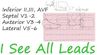 How To Read ECG Step By Step Part 3 of 3 (12 lead interpretation)