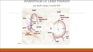 Physiological Pacing   Dr  Brian Vezi