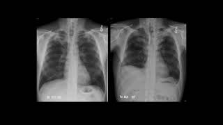 selection of patient for TB surgery #diseaseawareness #medicaleducation , like , share &subscribe