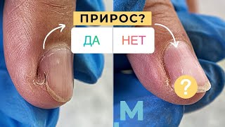 ПРОДОЛЬНАЯ ТРЕЩИНА на ногте: ДИНАМИКА 💅 Градиент по АКРИЛОВОЙ ПУДРЕ