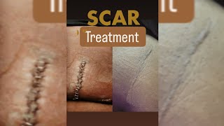 My at home scar therapy treatment