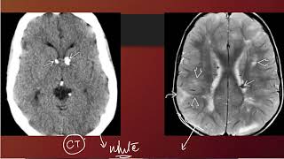 Neurocutaneous Syndromes (Part 2) by Dr. Zainab Vora