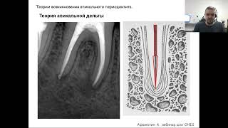 Вебинар №5 - Битва за стерильность, или лечение инфицированных каналов.