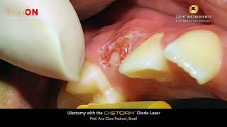 Ulectomy with the D-Storm™ Diode Laser