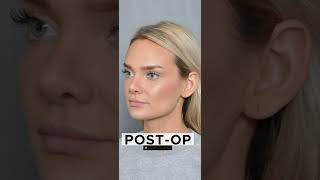 Before and After Ultrasonic Rhinoplasty