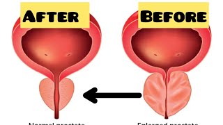 How to Shr!nk an ENLARGED pro$tate naturally….