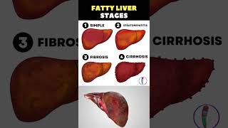 Fatty liver stages | Liver cirrhosis | Liver disaese | Liver detox