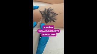 Scapă de tatuajele nedorite cu Picolaser #shorts