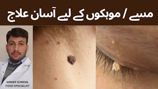 Easy treatment for warts or skin tags | مسے / موہکوں کے لیے آسان علاج | Benefits of castor oil