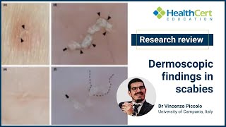 Dermoscopic findings in scabies | Dr Vincenzo Piccolo