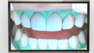 Treatments - Teeth Whitening Procedure