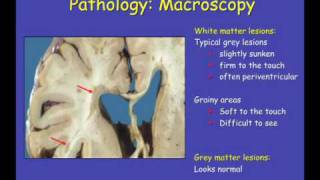 Sandra Amor PART 2 - How do we protect nerve cells  looking at lesions  what do we see?