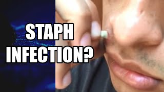 Face Cyst?  Staph Infected Cyst Extraction?  What is it?  Largest Infected Pimple