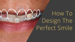 Designing the Perfect Veneers or All on 4 Smile