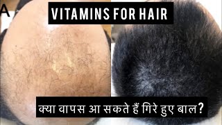 MULTIVITAMIN TO GROW HAIR|MARS BY GHC HAIR GUMMIES|REGROW HAIR|Finasteride|minoxidil|Results|Patch