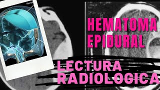 📚⚠️⭕LECTURA RADIOLOGICA ( HEMATOMA EPIDURAL) 🧐🧐